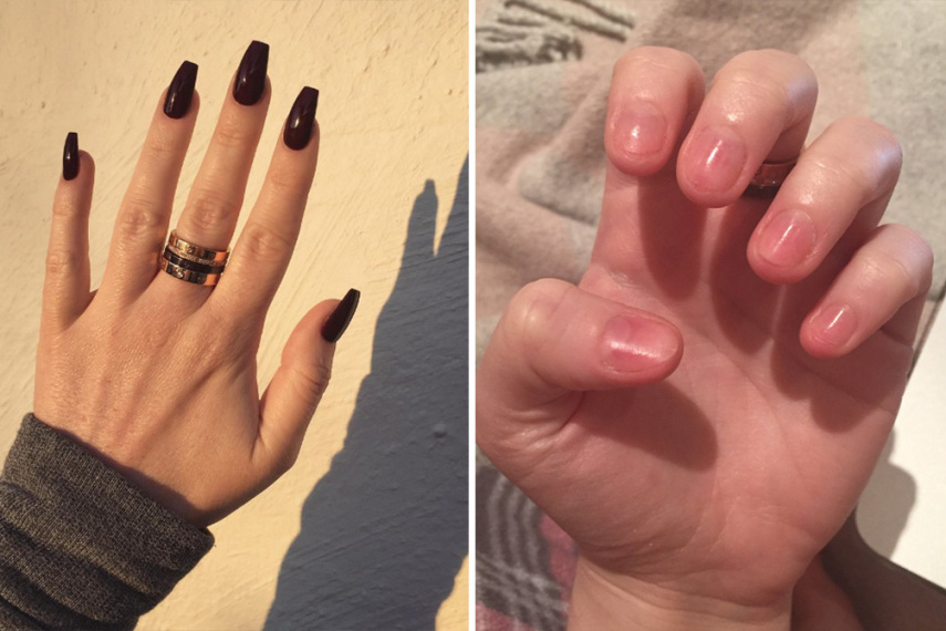 Antes e depois: unhas em recuperação