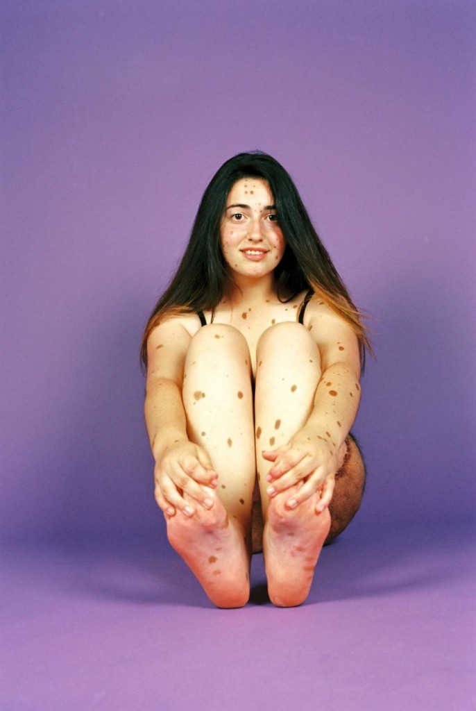 Alba Parejo nasceu com mais de 500 pintas e pelos amarronzados por todo o seu corpo."Meu ex-namorado disse para eu não mostrar minhas costas para ninguém, porque ninguém quer ter uma namorada deformada", compartilhou Alba.