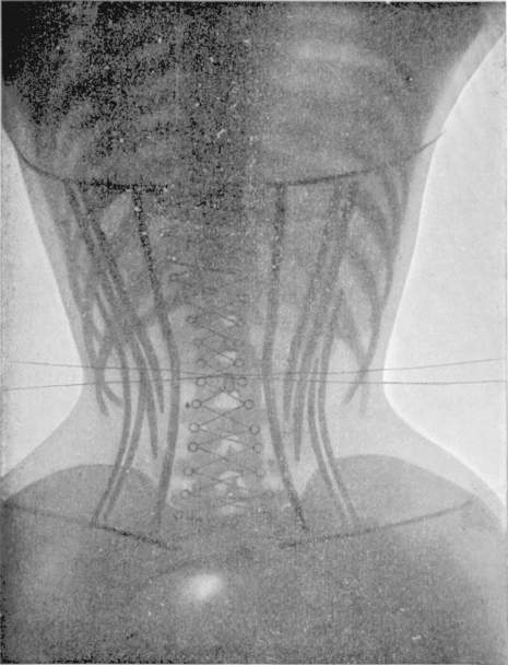 As chapas de raio-x estão no livro Le Corset, publicado pelo Dr. O'Followell em 1908