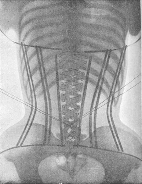 As chapas de raio-x estão no livro Le Corset, publicado pelo Dr. O'Followell em 1908