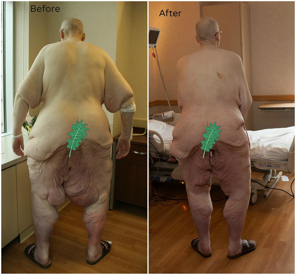 Homem que era o mais pesado do mundo mostra foto de antes e depois da cirurgia de remoção de pele