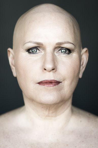 A fotógrafa Sigga Ella registrou sete mulheres com Alopecia a fim de conscientizar sofre a doença