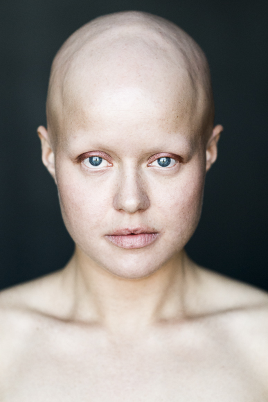 A fotógrafa Sigga Ella registrou sete mulheres com Alopecia a fim de conscientizar sofre a doença