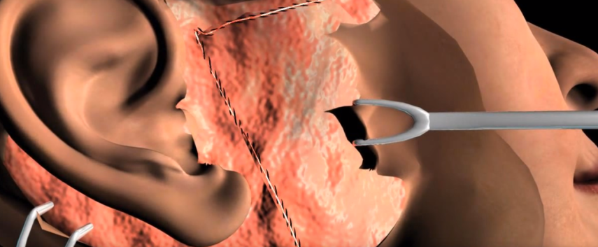 Na sala de cirurgia: é feito o reposicionamento do músculo com pontos para fixar, reposição de volume e a sobra de pele é removida, de acordo com o especialista