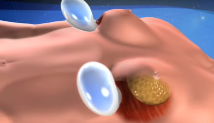 Na sala de cirurgia: segundo ele, a cirurgia feita com corte ao redor da aréola tem melhores resultados