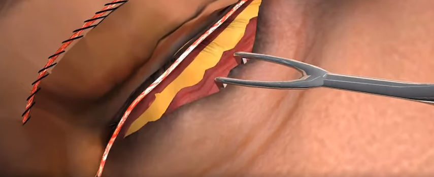 Na sala de cirurgia: a cirurgia retira as “bolsas” na parte superior das pálpebras e inferior aos olhos, que dão ar de cansaço