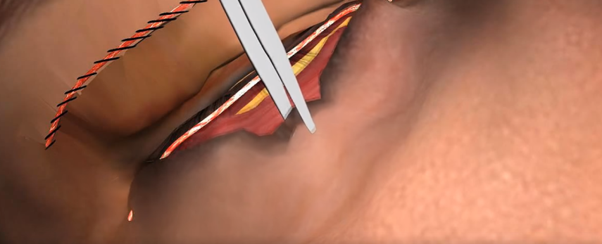 Na sala de cirurgia: o procedimento pode ser feito na parte superior aos olhos e inferior