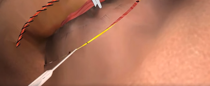 Na sala de cirurgia: o procedimento pode ser feito na parte superior aos olhos e inferior