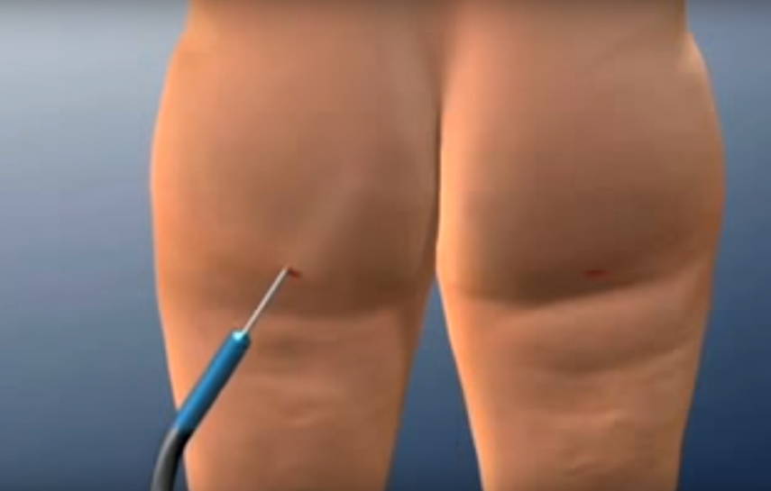 Na sala da cirurgia: dependendo da área, o especialista faz aspiração de camadas mais profundas ou superficiais