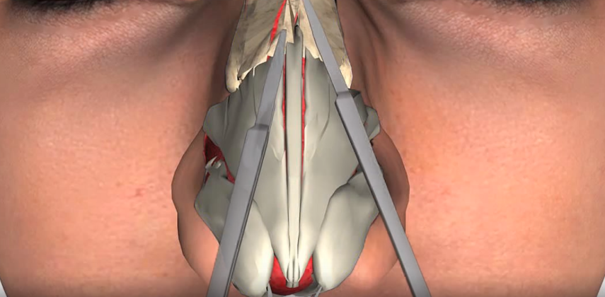 Na sala de cirurgia: o procedimento é realizado com uma serrinha especial