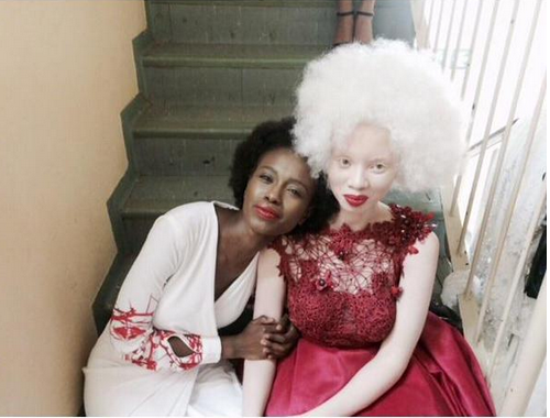 A sul-africana Thando Hopa, que é albina, superou suas limitações e hoje é uma referência para crianças que vivem com albinismo em sua terra natal. Ao se tornar modelo, inspirou muitas mulheres com sua história