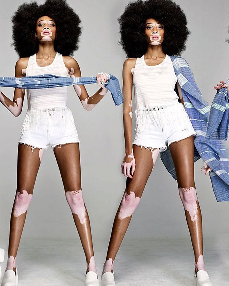 Modelo internacional famosíssima, Winnie Harlow já estrelou campanhas das grifes mais tops. O vitiligo não impede a gata de fazer nada (quem segue a moça nas redes sociais sabe disso), e acabou se transformando em sua marca registrada