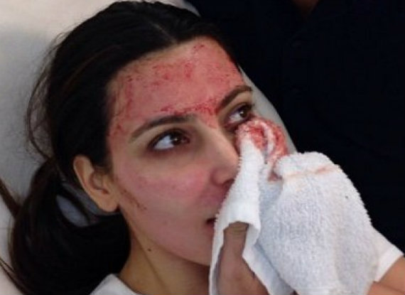 Kim Kardashian usa o próprio sangue para tratar a pele do rosto