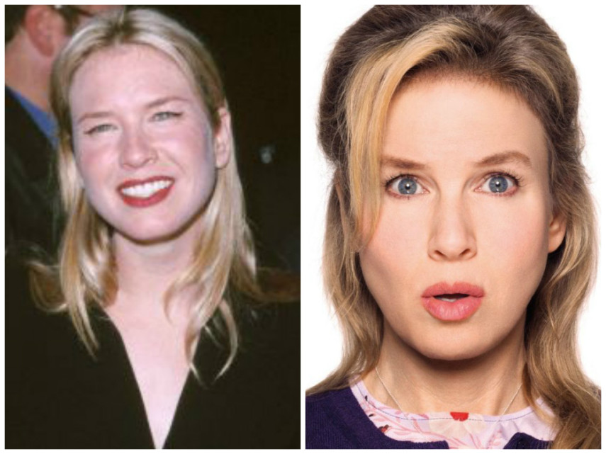 Renée Zellweger já teria feito bichectomia para mudar o contorno da face