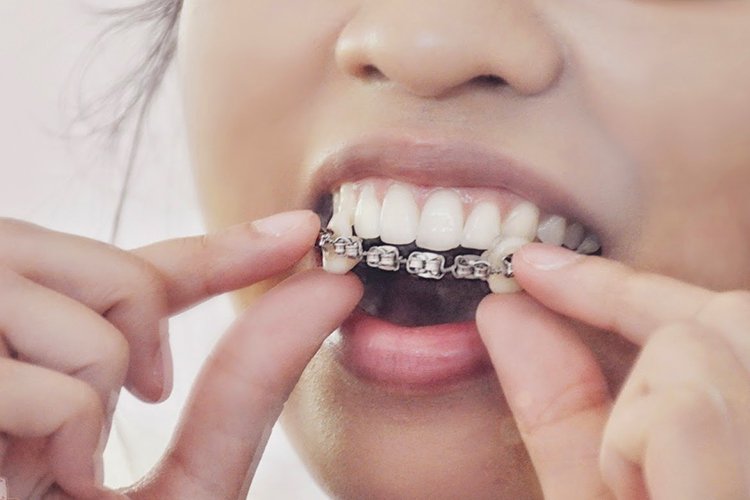 Essa moda pegou no Brasil e muita gente começou a colocar aparelho para ficar mais bonitão. Alguns não eram falsos e colocados por pessoas que não eram dentistas. Colocar aparelho nos dentes sem necessidade pode causar danos reais nos dentes. Melhor não inventar moda, né?