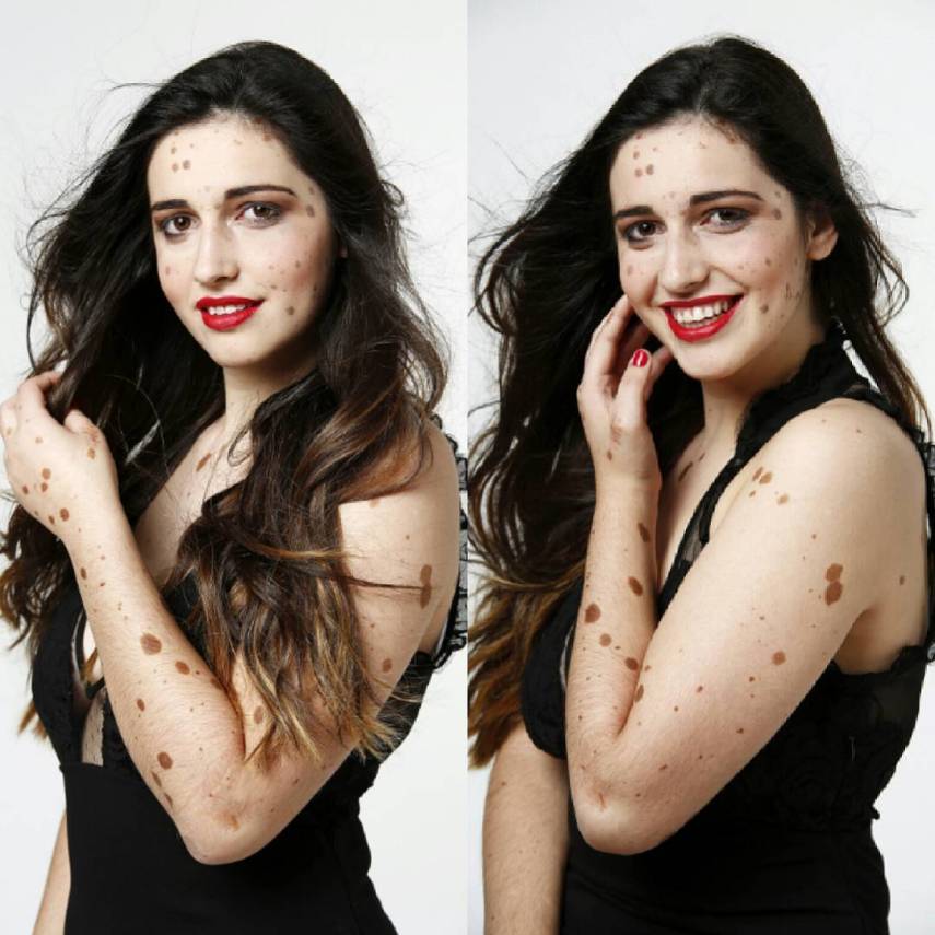 Alba Parejo, de Barcelona, tem mais de 500 manchas e marcas espalhadas pelo corpo. Apesar do sofrimento e do passado de bullying, ela insiste e persiste na carreira de modelo. Apenas maravilhosa!