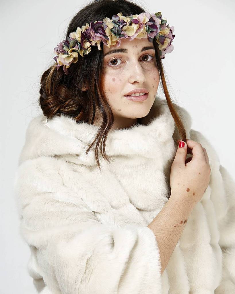 Alba Parejo, de Barcelona, tem mais de 500 manchas e marcas espalhadas pelo corpo. Apesar do sofrimento e do passado de bullying, ela insiste e persiste na carreira de modelo. Apenas maravilhosa!