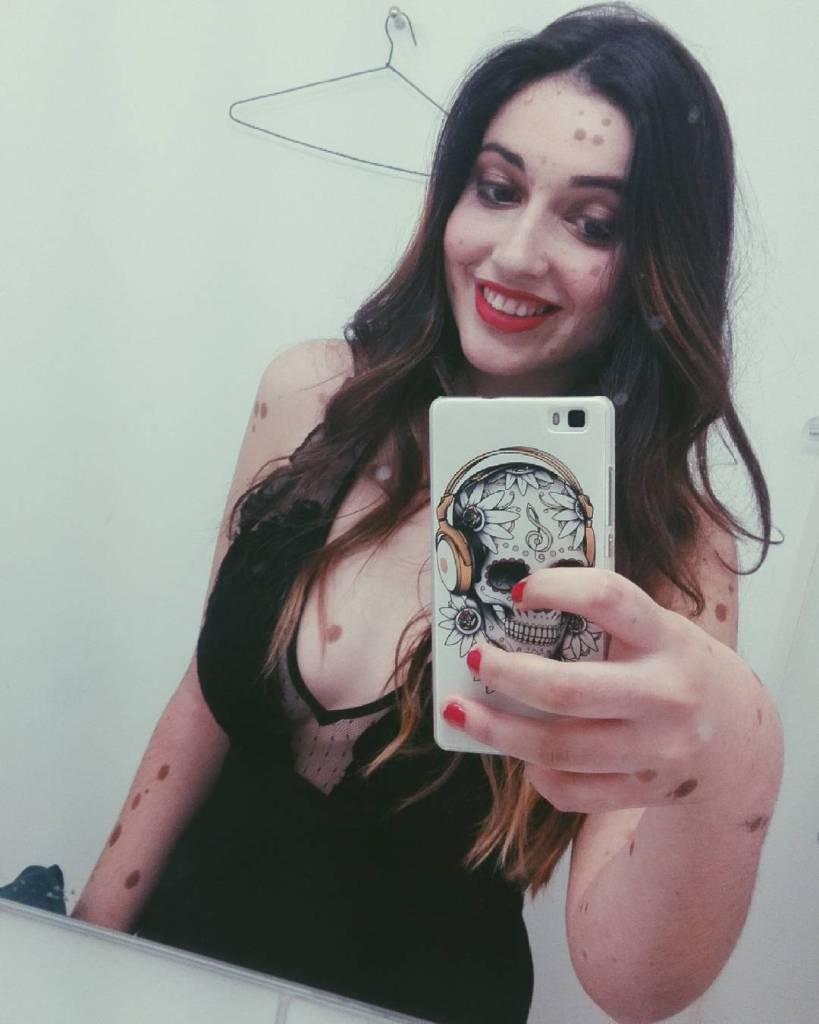 Alba Parejo, de Barcelona, tem mais de 500 manchas e marcas espalhadas pelo corpo. Apesar do sofrimento e do passado de bullying, ela insiste e persiste na carreira de modelo. Apenas maravilhosa!