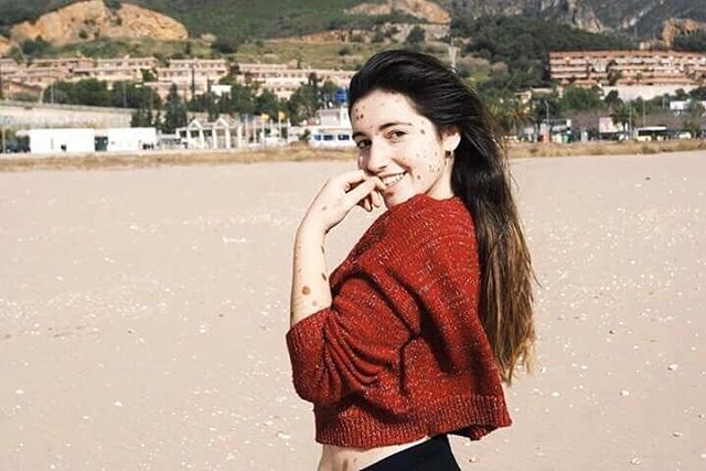 Alba Parejo, de Barcelona, tem mais de 500 manchas e marcas espalhadas pelo corpo. Apesar do sofrimento e do passado de bullying, ela insiste e persiste na carreira de modelo. Apenas maravilhosa!