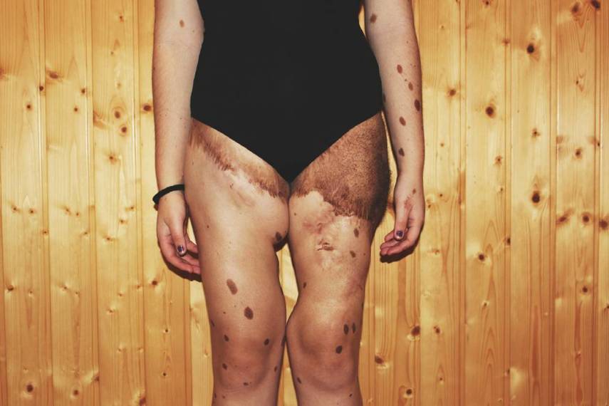 Alba Parejo, de Barcelona, tem mais de 500 manchas e marcas espalhadas pelo corpo. Apesar do sofrimento e do passado de bullying, ela insiste e persiste na carreira de modelo. Apenas maravilhosa!