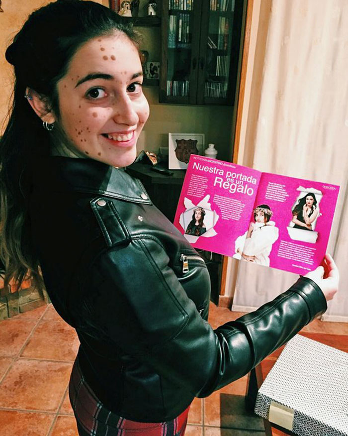 Alba Parejo, de Barcelona, tem mais de 500 manchas e marcas espalhadas pelo corpo. Apesar do sofrimento e do passado de bullying, ela insiste e persiste na carreira de modelo. Apenas maravilhosa!