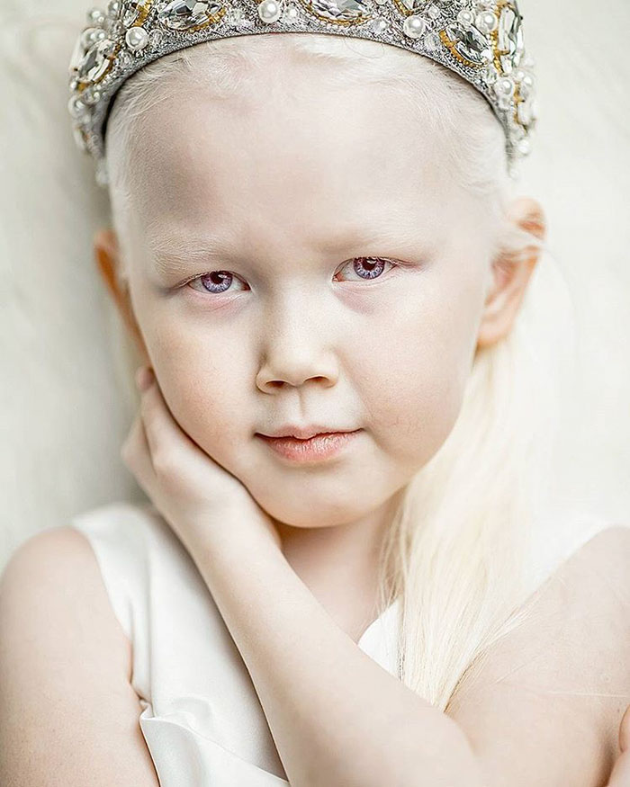 'Branca de Neve siberiana', albina de 8 anos recebe convites para ser modelo