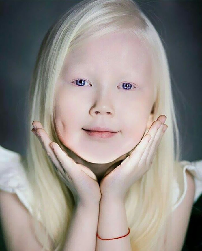 'Branca de Neve siberiana', albina de 8 anos recebe convites para ser modelo
