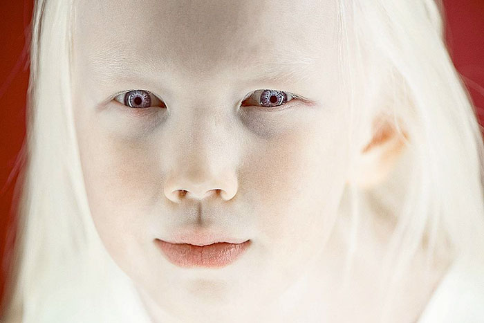 'Branca de Neve siberiana', albina de 8 anos recebe convites para ser modelo