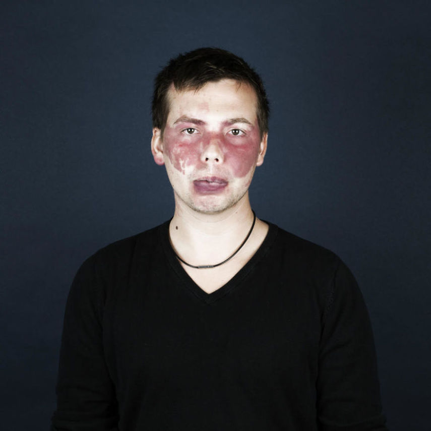 A fotógrafa Linda Hansen, que vive em Copenhague, resolveu fazer uma série de retrato de pessoas que tem marcas de nascença. O projeto ganhou o nome de Nevus Flammeus e tem como objetivo mostrar a beleza única dessas marcas ou sinais.