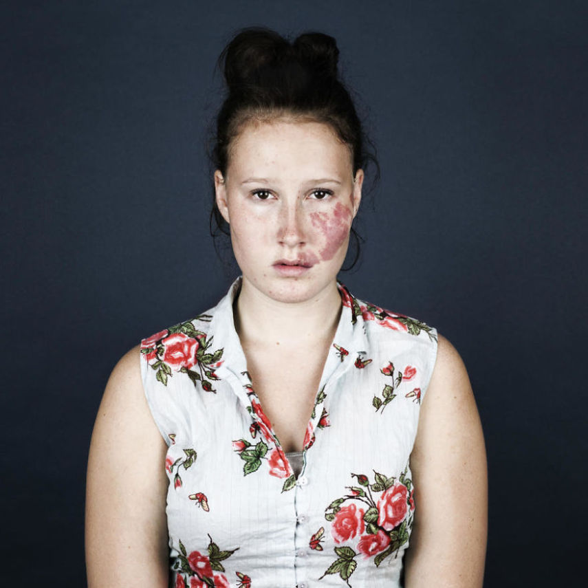 A fotógrafa Linda Hansen, que vive em Copenhague, resolveu fazer uma série de retrato de pessoas que tem marcas de nascença. O projeto ganhou o nome de Nevus Flammeus e tem como objetivo mostrar a beleza única dessas marcas ou sinais.