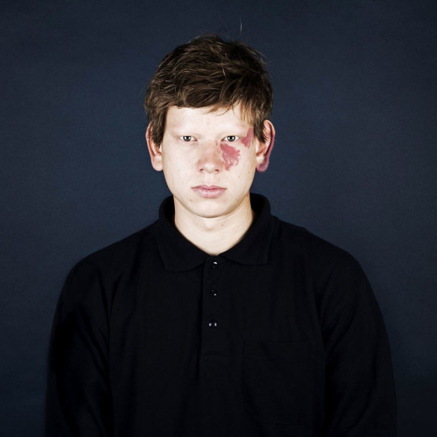 A fotógrafa Linda Hansen, que vive em Copenhague, resolveu fazer uma série de retrato de pessoas que tem marcas de nascença. O projeto ganhou o nome de Nevus Flammeus e tem como objetivo mostrar a beleza única dessas marcas ou sinais.