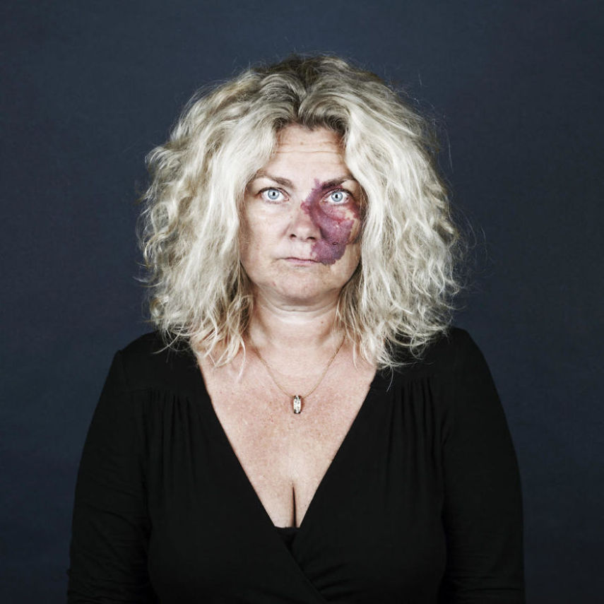 A fotógrafa Linda Hansen, que vive em Copenhague, resolveu fazer uma série de retrato de pessoas que tem marcas de nascença. O projeto ganhou o nome de Nevus Flammeus e tem como objetivo mostrar a beleza única dessas marcas ou sinais.