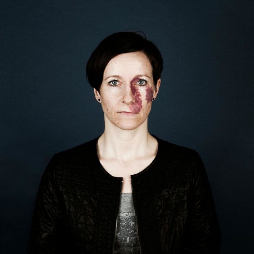 A fotógrafa Linda Hansen, que vive em Copenhague, resolveu fazer uma série de retrato de pessoas que tem marcas de nascença. O projeto ganhou o nome de Nevus Flammeus e tem como objetivo mostrar a beleza única dessas marcas ou sinais.