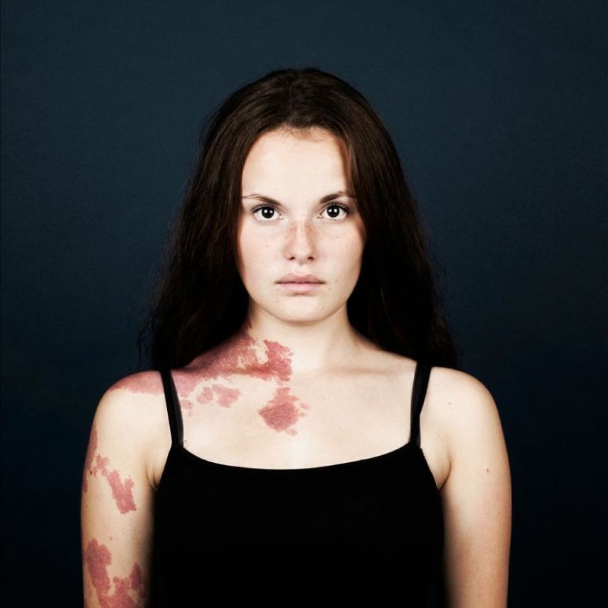 A fotógrafa Linda Hansen, que vive em Copenhague, resolveu fazer uma série de retrato de pessoas que tem marcas de nascença. O projeto ganhou o nome de Nevus Flammeus e tem como objetivo mostrar a beleza única dessas marcas ou sinais.