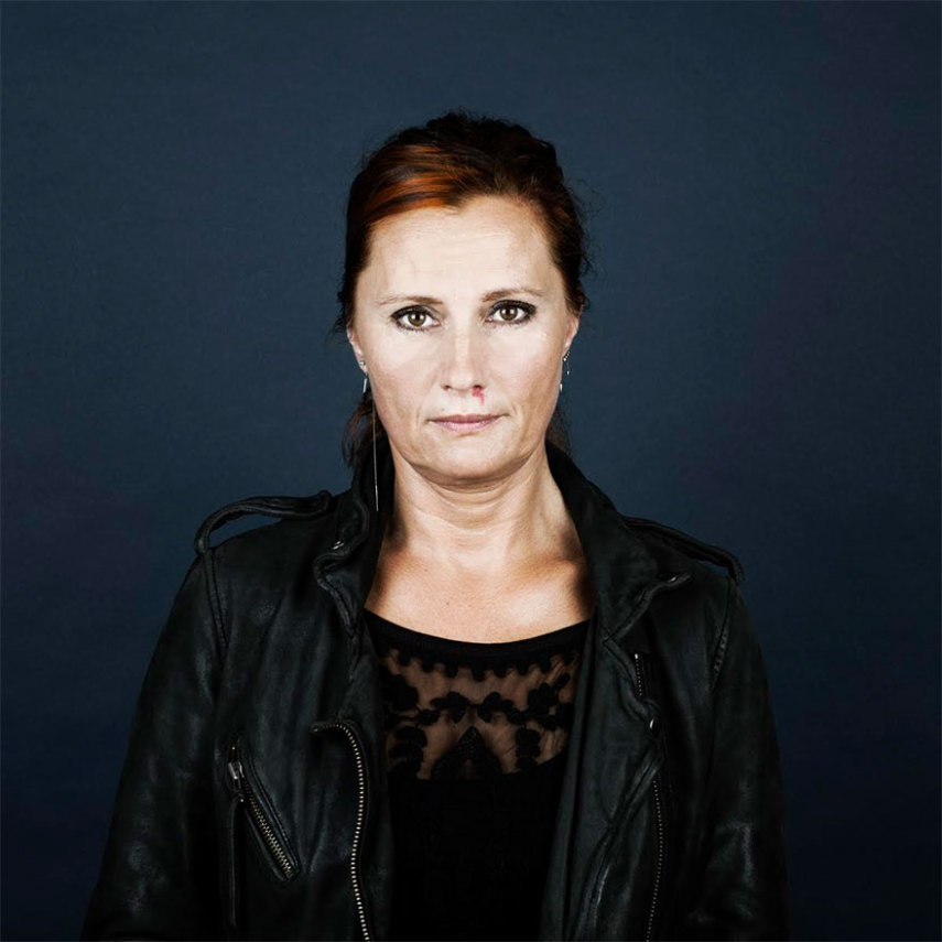 A fotógrafa Linda Hansen, que vive em Copenhague, resolveu fazer uma série de retrato de pessoas que tem marcas de nascença. O projeto ganhou o nome de Nevus Flammeus e tem como objetivo mostrar a beleza única dessas marcas ou sinais.