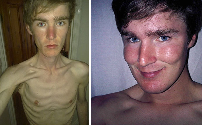 Esse jovem venceu a anorexia e hoje conta sua experiência em um blog.