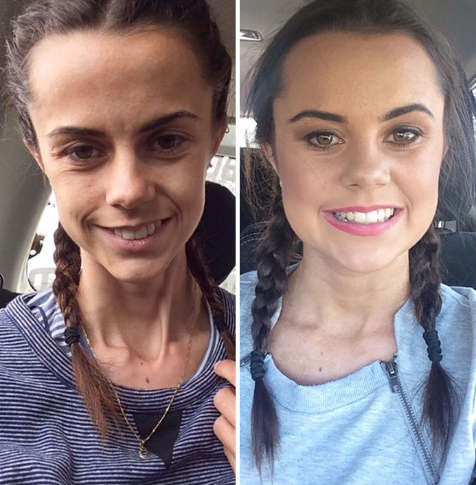 Antes de procurar ajuda médica, Claire Mercer chegou a pesar 25 kg.