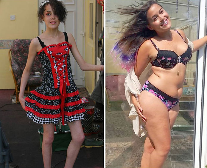 Depois de vencer a doença, Megan Jayne Crabbe aderiu ao movimento #bodypositive nas redes sociais.