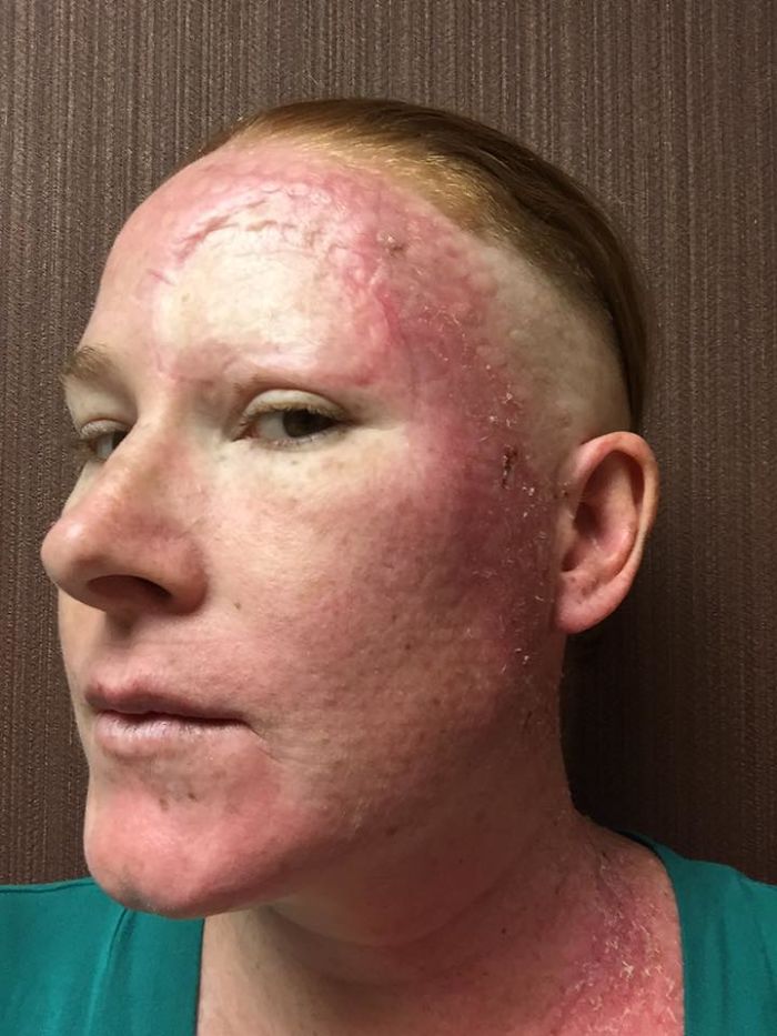 Bethany Gambardella-Greenway, 39 anos, é mãe de duas filhas e está em uma missão de alertar pessoas para a realidade do câncer de pele e tem documentado com uma foto por dia sua batalha contra um melanoma na pele