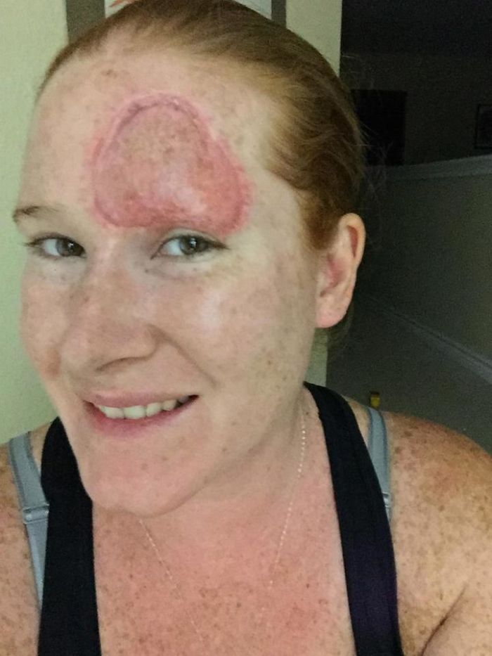 Bethany Gambardella-Greenway, 39 anos, é mãe de duas filhas e está em uma missão de alertar pessoas para a realidade do câncer de pele e tem documentado com uma foto por dia sua batalha contra um melanoma na pele