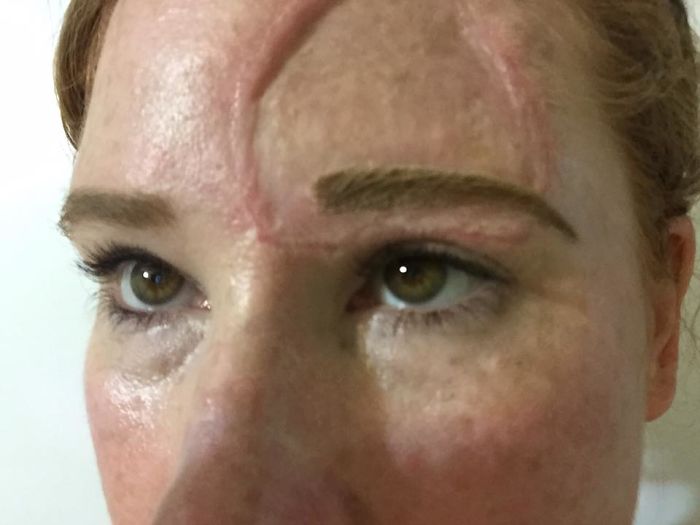 Bethany Gambardella-Greenway, 39 anos, é mãe de duas filhas e está em uma missão de alertar pessoas para a realidade do câncer de pele e tem documentado com uma foto por dia sua batalha contra um melanoma na pele
