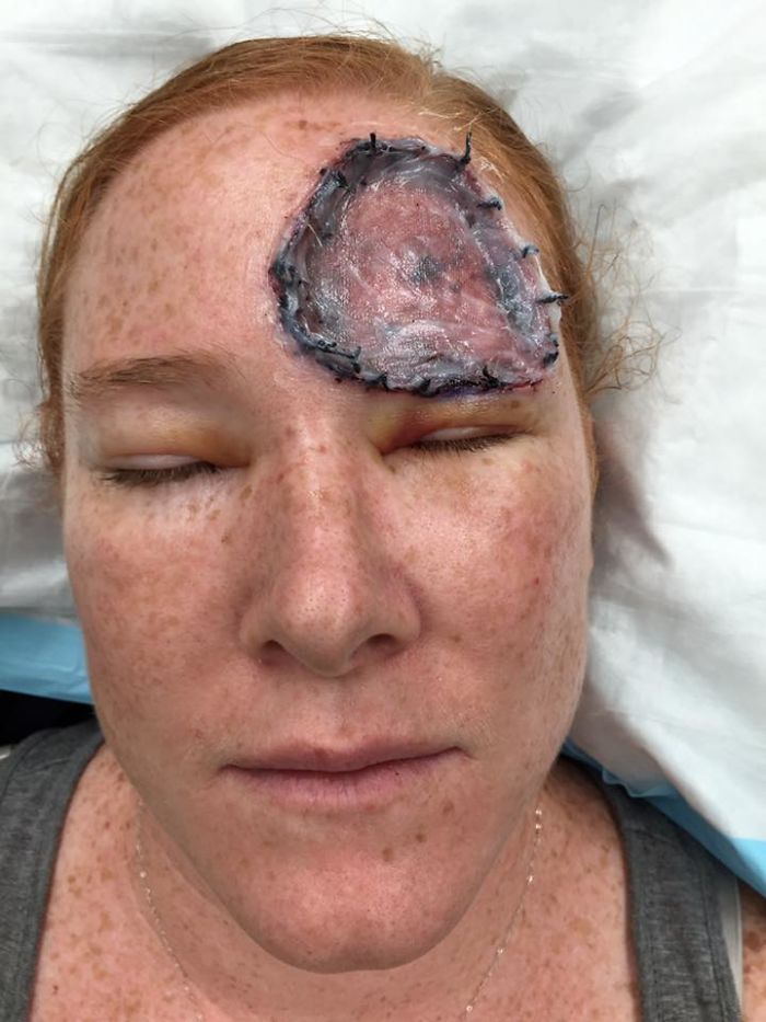 Bethany Gambardella-Greenway, 39 anos, é mãe de duas filhas e está em uma missão de alertar pessoas para a realidade do câncer de pele e tem documentado com uma foto por dia sua batalha contra um melanoma na pele