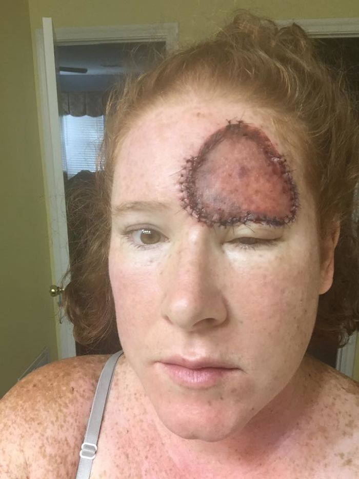 Bethany Gambardella-Greenway, 39 anos, é mãe de duas filhas e está em uma missão de alertar pessoas para a realidade do câncer de pele e tem documentado com uma foto por dia sua batalha contra um melanoma na pele