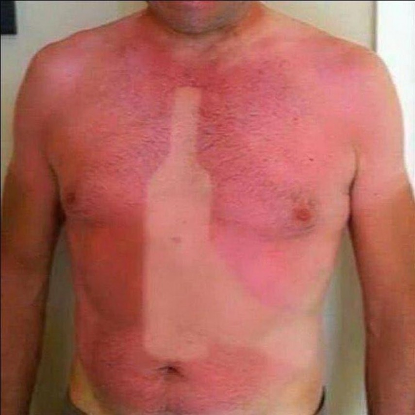 Piores queimaduras de sol