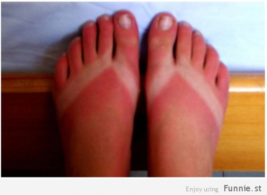 Piores queimaduras de sol