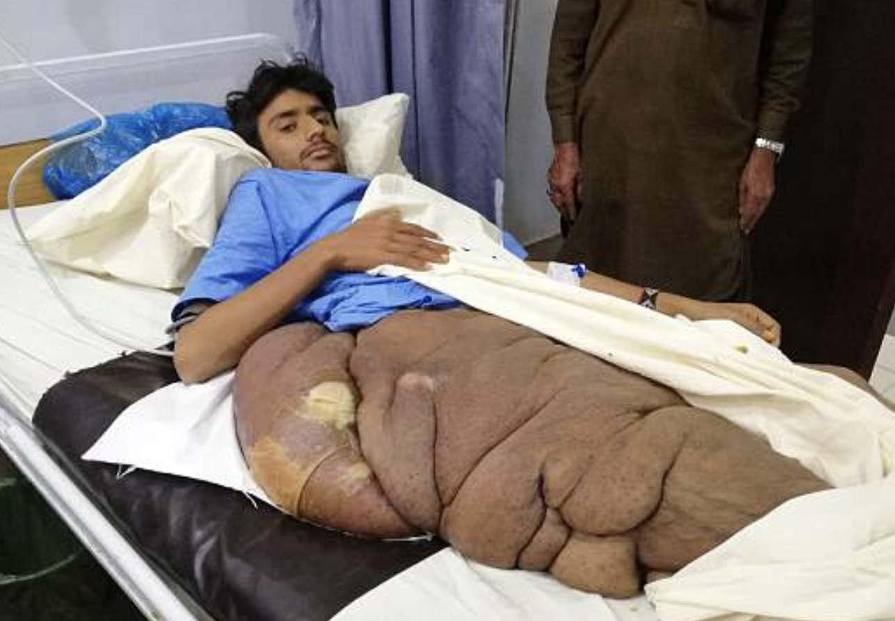 Paquistanês remove tumor gigante de 31 kg no quadril em cirurgia