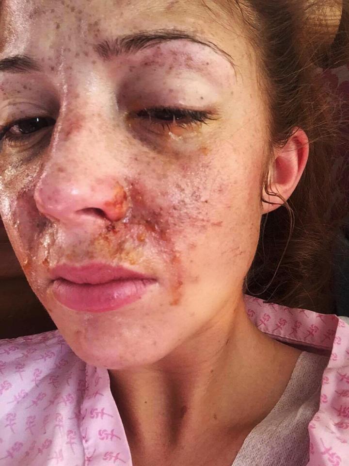 Vítima de ataque a ácido é finalista de concurso de beleza