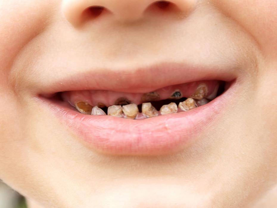 Sorriso de refrigerante: dentes podres podem virar rótulo de bebidas doces