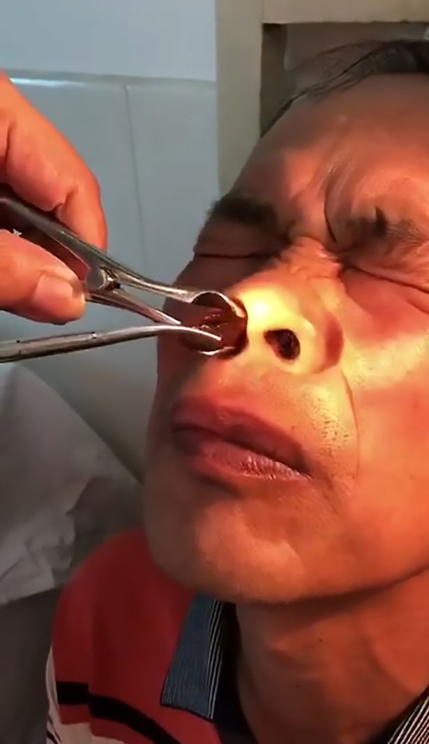Médico remove larva gigante de nariz de paciente na China