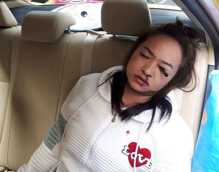 Em acidente de táxi, jovem acaba com lápis de maquiagem preso no olho
